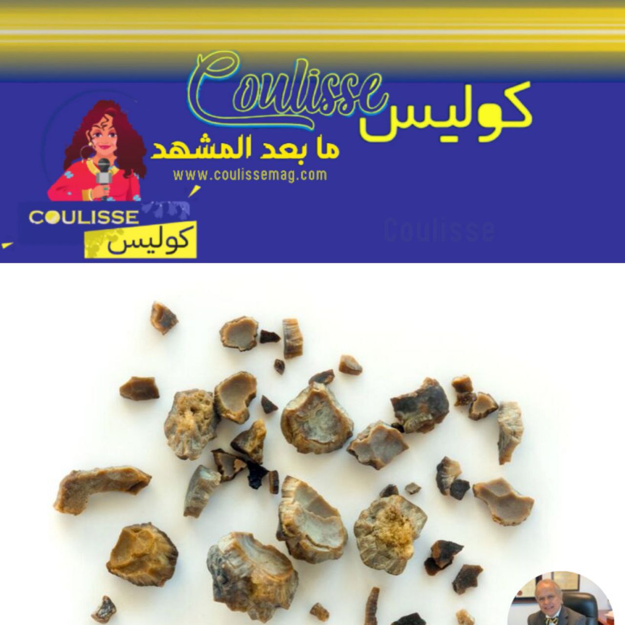 الأطباء يستخرجون 30 حصوة من كلية مريض واحد ما السبب