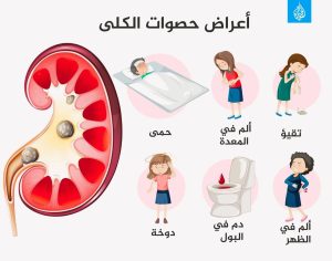 أهم ثلاث نصائح للوقاية من حصوات الكلى:الأولى: اشرب كمية كافية من الماء. الثانية: اتبع نظامًا غذائيًا صحيًا. الثالثة: لا تؤخر التبول.