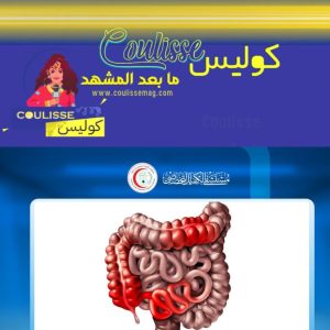 اكتشاف طبي مثير يستهدف داء كرون ما هو